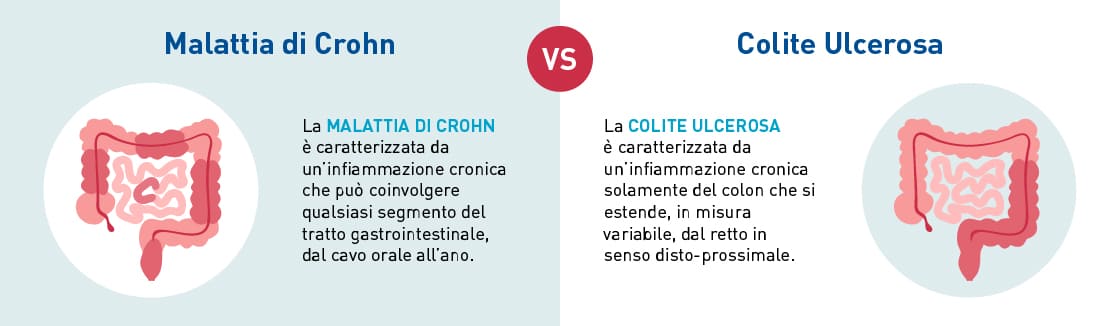 Confronto tra Malattia di Crohn e Colite Ulcerosa